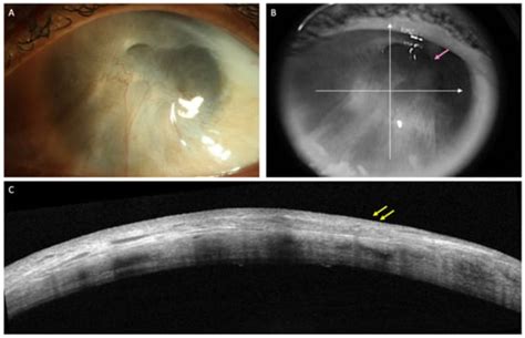 Diagnostics Free Full Text Role Of As Oct In Managing Corneal Disorders