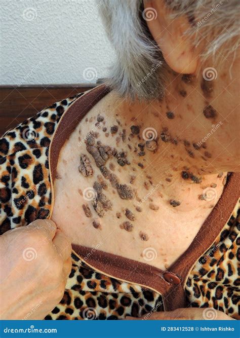Moles On The Neck. Birthmark On The Neck. Royalty-Free Stock