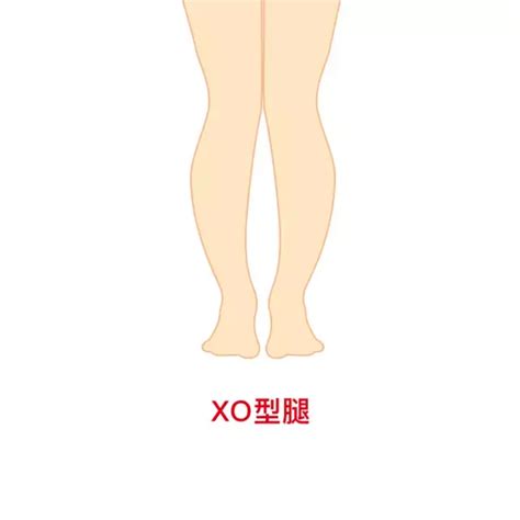 如何判断xo型腿的成因及合适的运动矫正方法？ 知乎