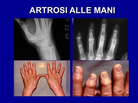 Artrosi Delle Mani Studio Ce Ma Sport