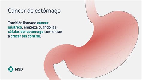 Msd Latam On Twitter ¿qué Es El Cáncer De Estómago 👇 1 2 Txhpwo8eq3 Twitter