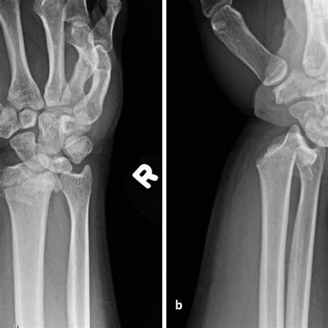 Posteroanterior Pa And Lateral Radiographs Of The Right Wrist Showing