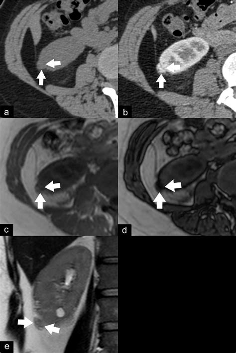 Figure 6 From The Different Faces Of Renal Angiomyolipomas On