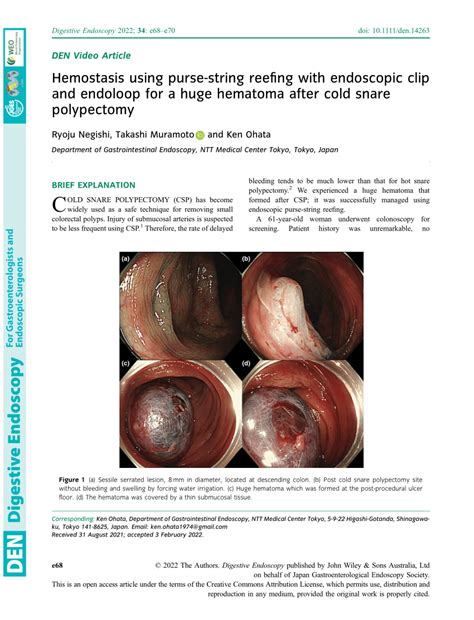 PDF Hemostasis Using Pursestring Reefing With Endoscopic Clip And