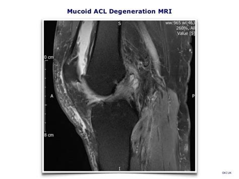 Mucoid ACL Degeneration