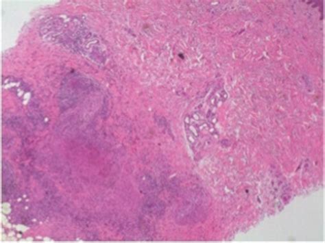 Figure 1 From Molluscum Like Papules As A Presentation Of Early