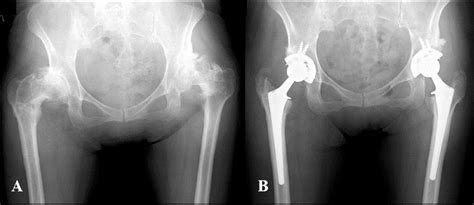 Pre And Postoperative Radiographs Of The Bilateral Hip Joint Of A