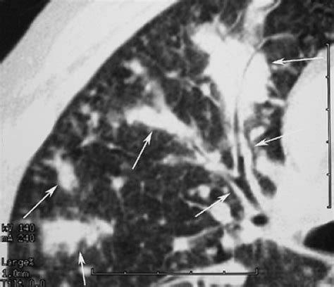 Diffuse Lung Disease Radiology Key