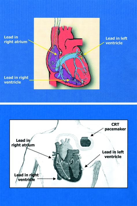 Cardiac Resynchronization Therapy A Patients Guide Circulation