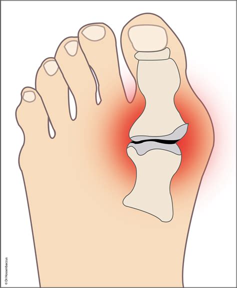 Docteur Hossenbaccus Pied Hallux Rigidus Arthrose Du Gros Orteil