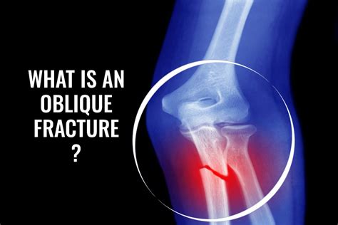 Oblique Fracture: Symptoms, Causes & Treatment | ER of Mesquite