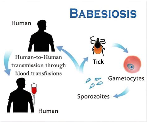 Babesiosis Symptoms Medizzy