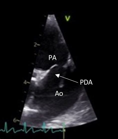 Patent Ductus Arteriosus Echo