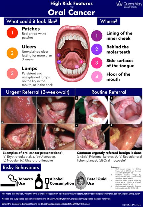 What Does Floor Of Mouth Cancer Feel Like | Viewfloor.co