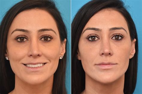 Injectable Fillers Photos Philadelphia Pa Patient