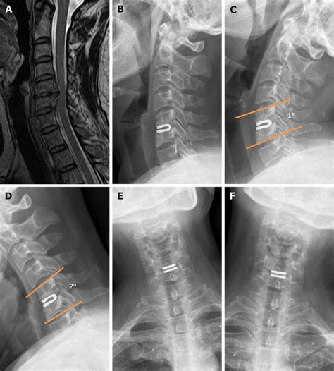 A 50 Year Old Woman Suffering From C5 6 Degenerative Disc Disease A Download Scientific