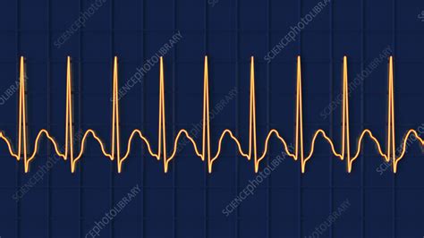 Atrial Flutter Abnormal Heartbeat Rhythm Illustration Stock Image