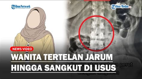 Viral Seorang Wanita Tertelan Jarum Pentul Dokter Jelaskan Kondisinya