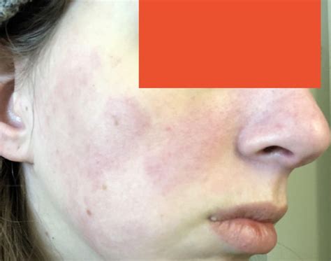 Demodex die off control? : r/Rosacea