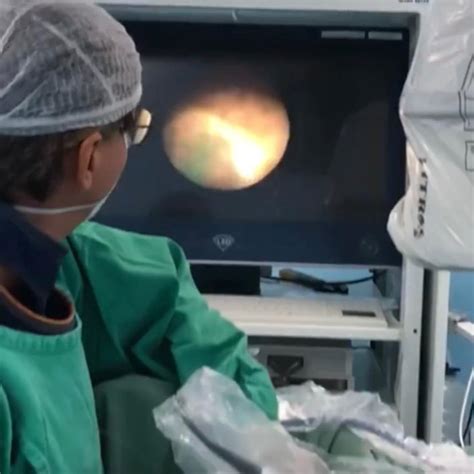 Martag O Realiza Primeira Cirurgia De C Lculo Renal Por Laser Do