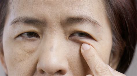 What Causes Ptosis Mccracken Eye And Face Institute