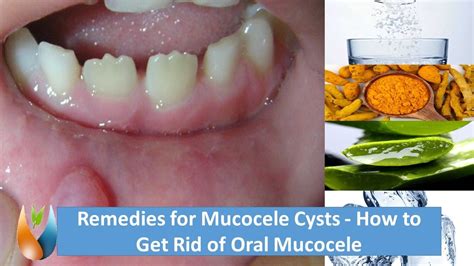 Remedies For Mucocele Cysts How To Get Rid Of Oral Mucocele Youtube