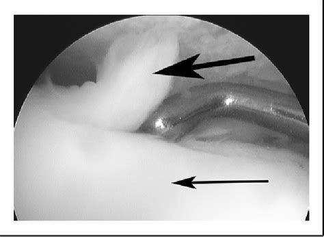 Figure From Viability Of Talus Osteochondral Defect Cartilage For