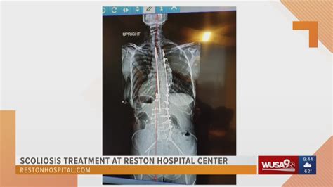 Advanced Scoliosis Treatment Provides Much Needed Relief To Patients At