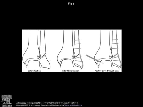 Arthroscopically Assisted Open Reduction Internal Fixation Of Ankle