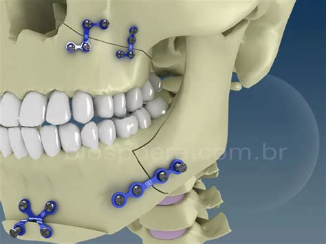Операция при переломе челюсти: все, что вам нужно знать | Медицинская ...