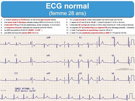 Ecg Normal E Cardiogram 13248 The Best Porn Website