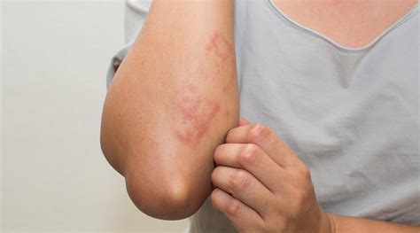 What Is Neurodermatitis And How Can You Treat It