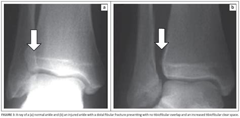 Dynamic Ultrasound Evaluation Of The Syndesmosis Ligamentous Complex