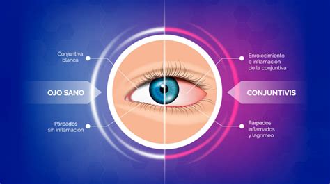 Alergia Ocular Cómo Saber Si Tienes Alergia En Los Ojos Visufarma Es