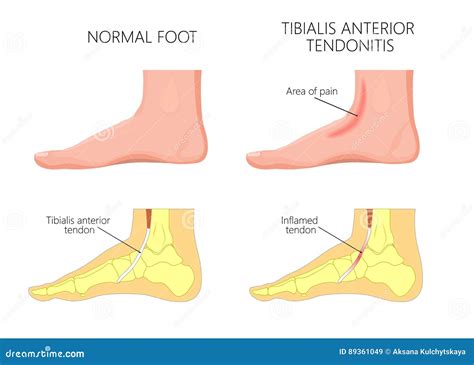 Medial Ankle Injury_Tibialis Anterior Tendonitis Cartoon Vector ...