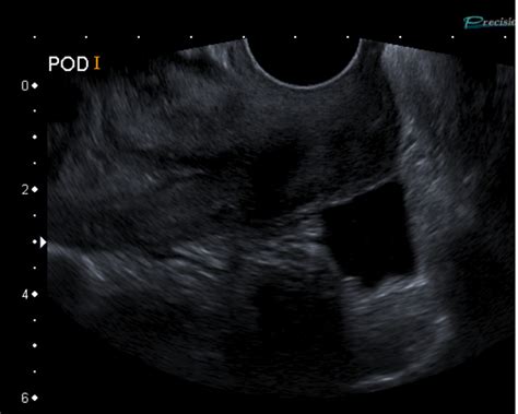 Transvaginal Ultrasound Scan Showing A Large Irregular Heterogenous