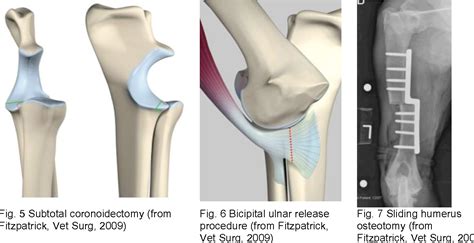 Figure 3 From Diagnosing Elbow Dysplasia And Current Treatment Options Semantic Scholar