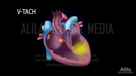 Alila Medical Media Ventricular Tachycardia And Ventricular