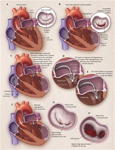 Secondary Mitral Regurgitation Nejm