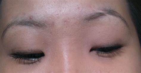 Beauty And The Bees: Eyebrow Has A Scar?