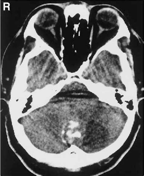 Figure 1 From Squamous Cell Carcinoma Arising In An Intracranial