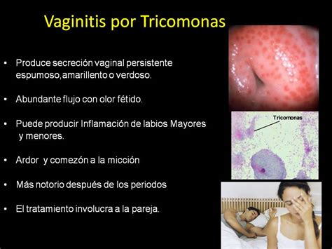 Salud Para La Mujer Y El Hombre Infecciones Vaginales Que Son Y Como