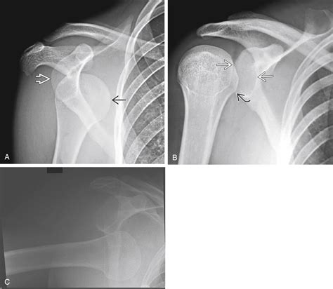 Shoulder Dislocation Clinical Tree