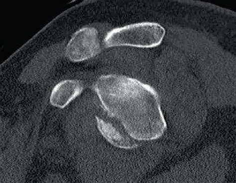 Sagittal Ct Image Demonstrating Large Anteroinferior Glenoid Rim