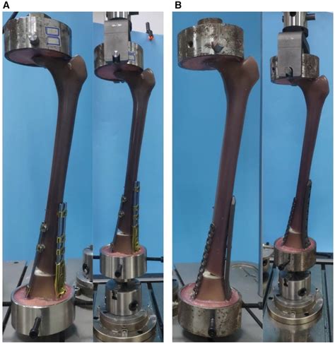 Frontiers Biomechanical Analysis Of Bridge Combined Fixation System