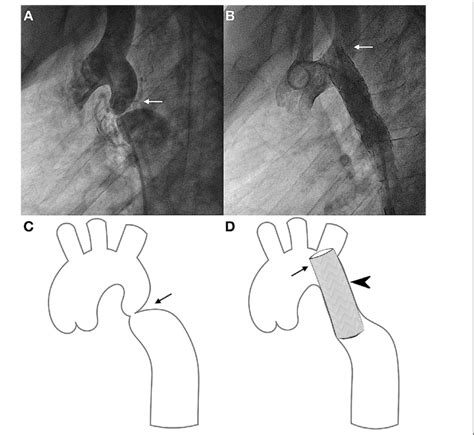 Initial Angiogram Aortogram In Lateral Viewa Shows Post Subclavian Download Scientific