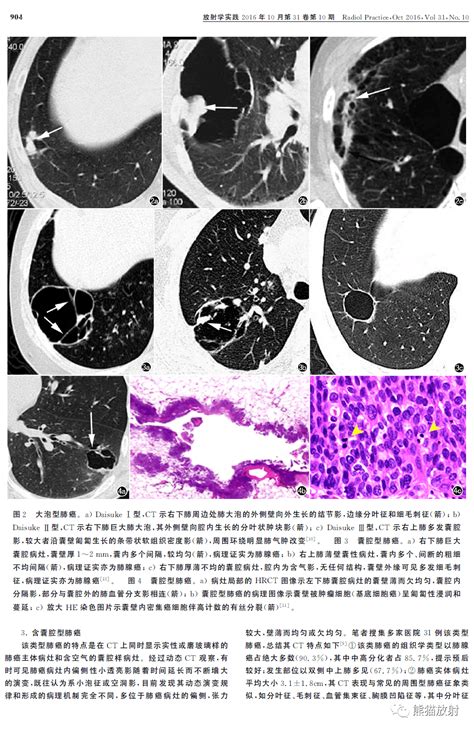 肺部囊腔类肺癌丨分型及其ct表现 诊断率