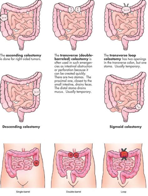 Interventions For Colostomyileostomy Colostomy Nerdy Nurse Ostomy