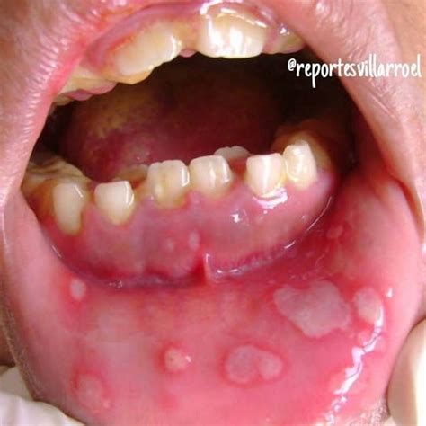 Herpes Bucal Odontoblog