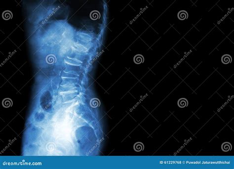 Spondylosis Spondylolisthesis Film X Ray Lumbo Sacral Spine Show